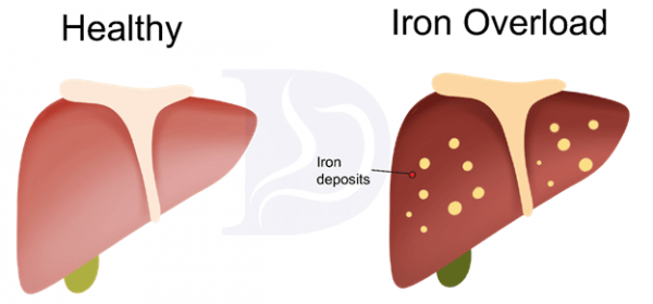 هموکروماتوز یا افزایش حجم آهن در بدن
