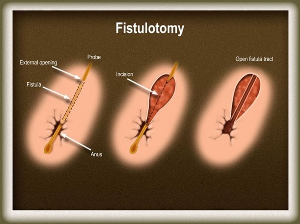 پزشکان فیستول کولون و آنورکتال را چگونه درمان می کنند؟