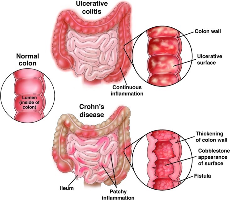 عوامل خطر IBD چیست؟