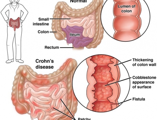 آنچه باید درباره بیماری کرون بدانید!