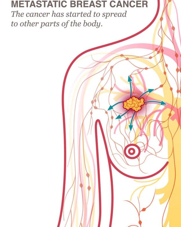 متاستاز: نحوه گسترش سرطان