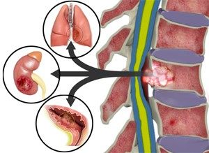سرطان متاستاتیک چگونه درمان می شود؟