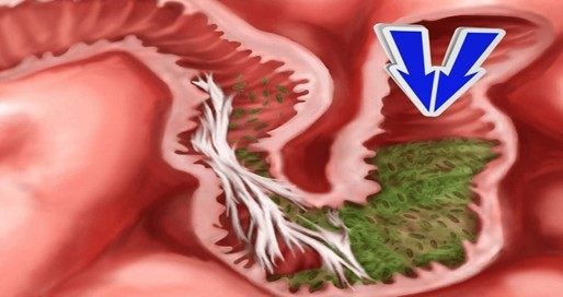 چرا رشد بیش از حد باکتری های روده کوچک ایجاد می شود؟