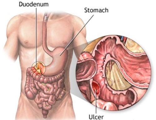 خونریزی دستگاه گوارش چیست؟