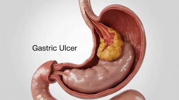 زخم های معده و اثنی عشر چگونه تشخیص داده می شوند؟